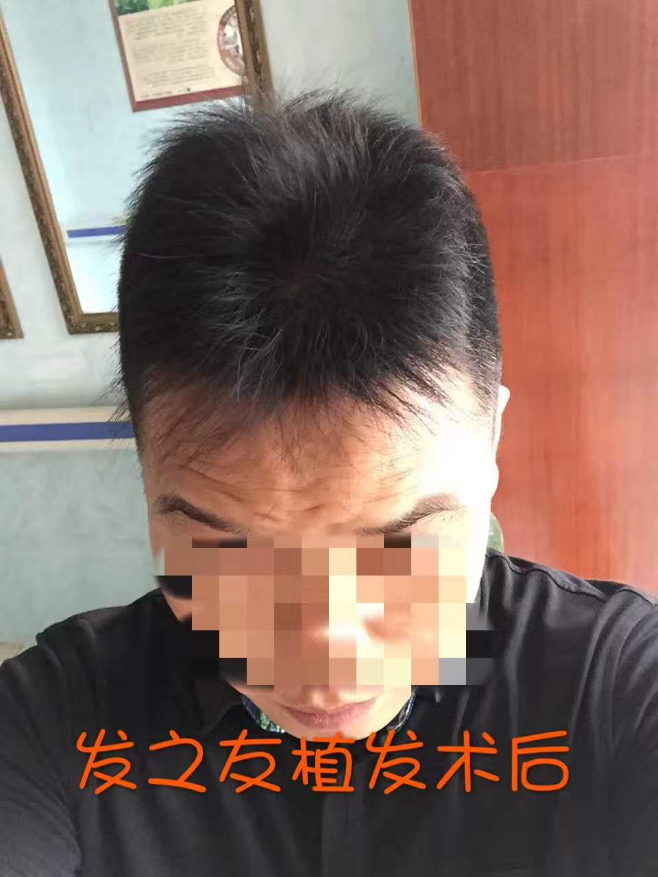 廣西脫發(fā)治療多少錢/發(fā)之友